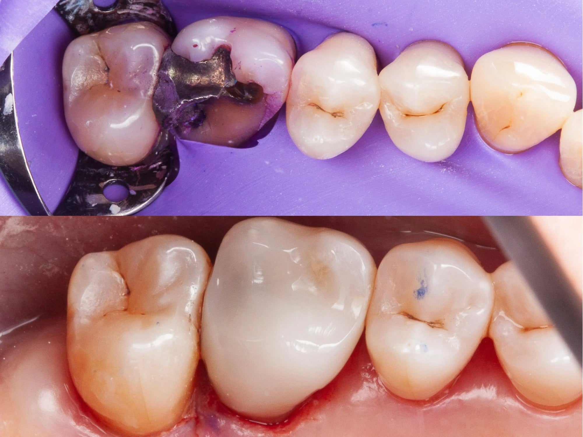 Before and after: amalgam filling replaced with tooth-colored material