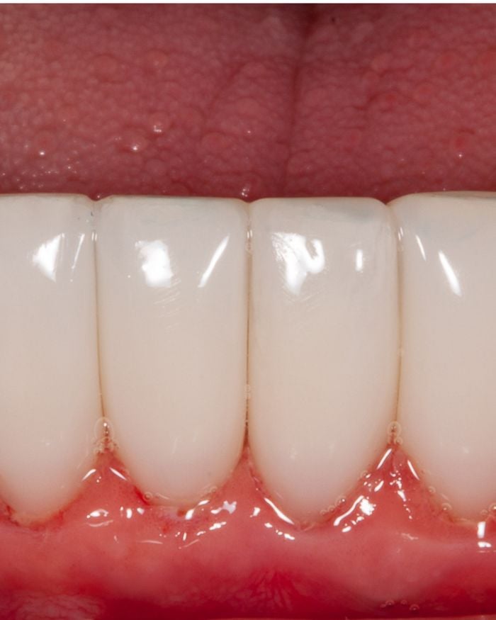 After: the spaces between the teeth are filled