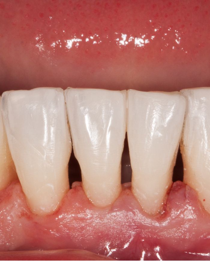Before: dark triangular spaces between teeth near the gum line