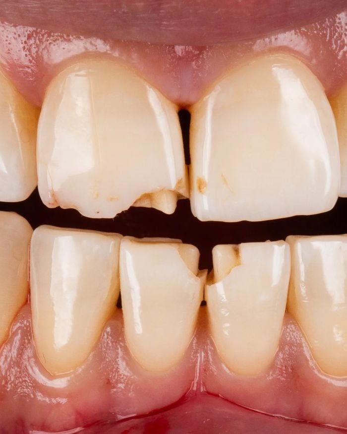 Before: chipped and worn biting edges on the upper front teeth
