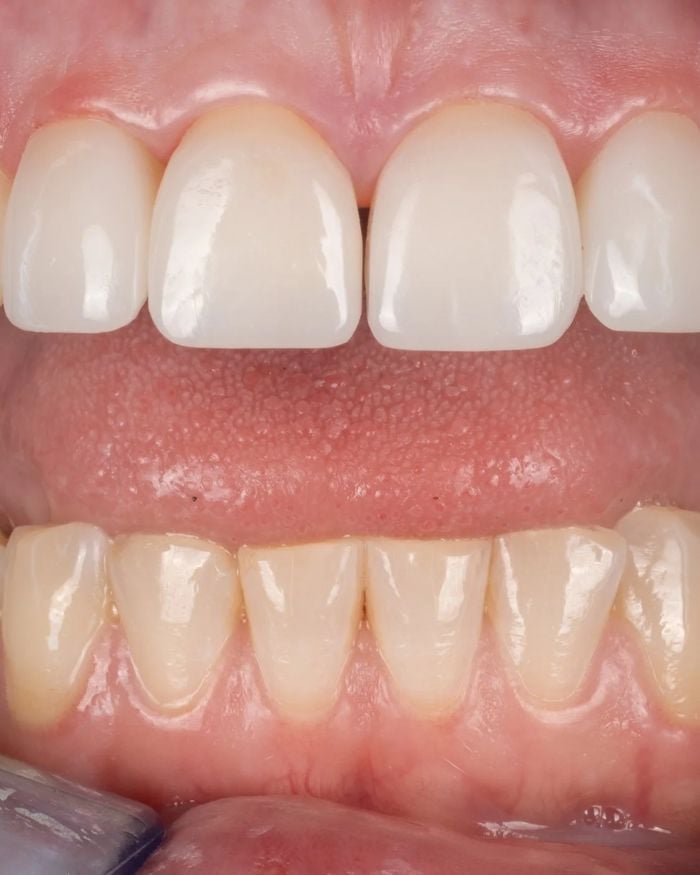After: the gap between the upper front teeth is closed