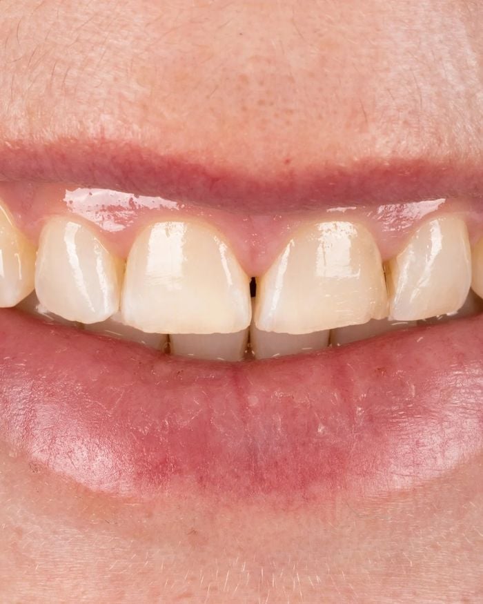 Before: a visible gap between the upper front teeth