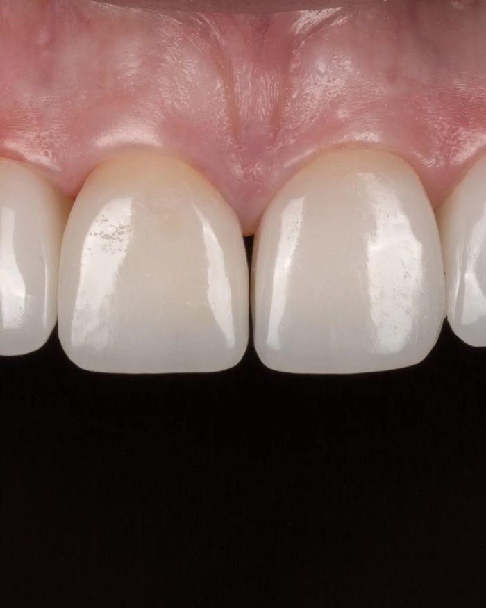 After: the two front teeth meet with no space