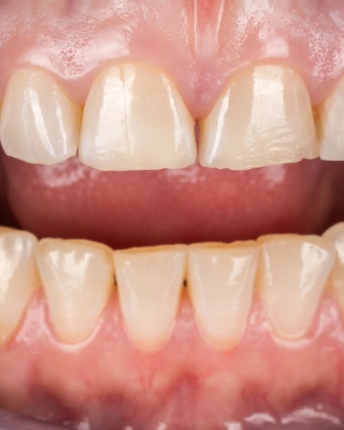 Before: a narrow space between two front teeth