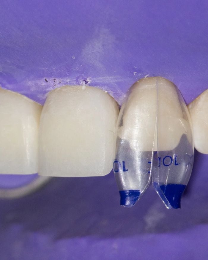 A clear Bioclear matrix fitted around a front tooth during a restoration