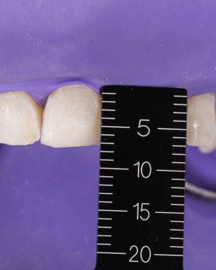 Upper front teeth isolated with a rubber dam while a measuring gauge is held against a tooth