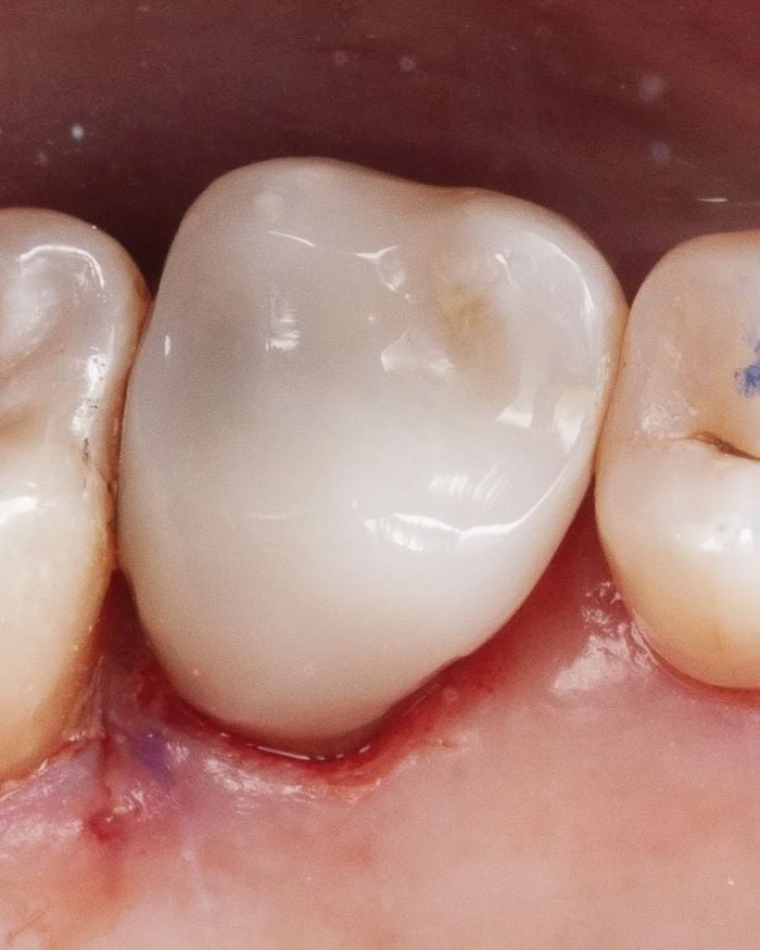 After: the finished molar restoration