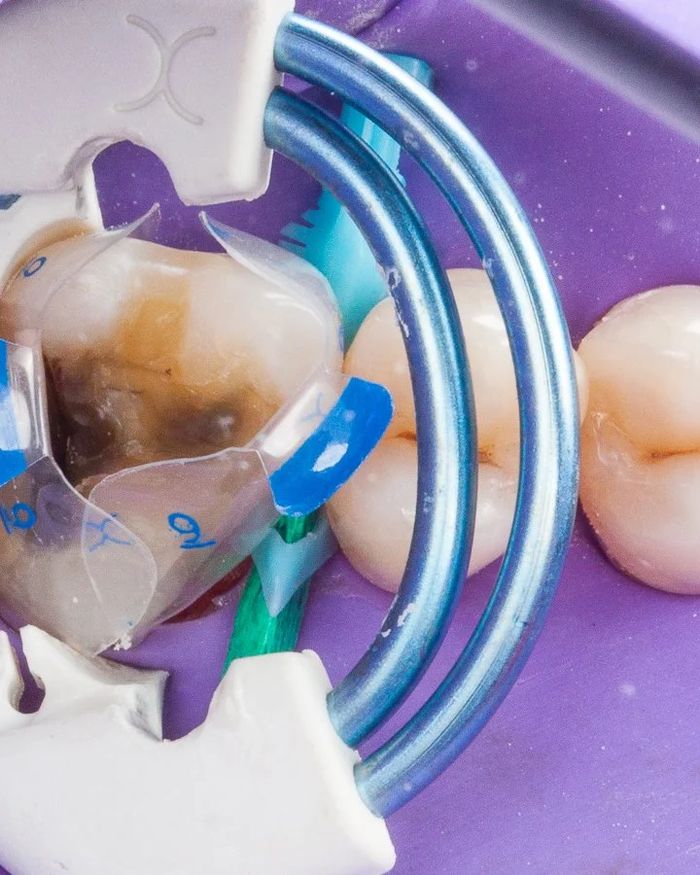 During treatment: a decayed molar with matrix bands and clamps in place