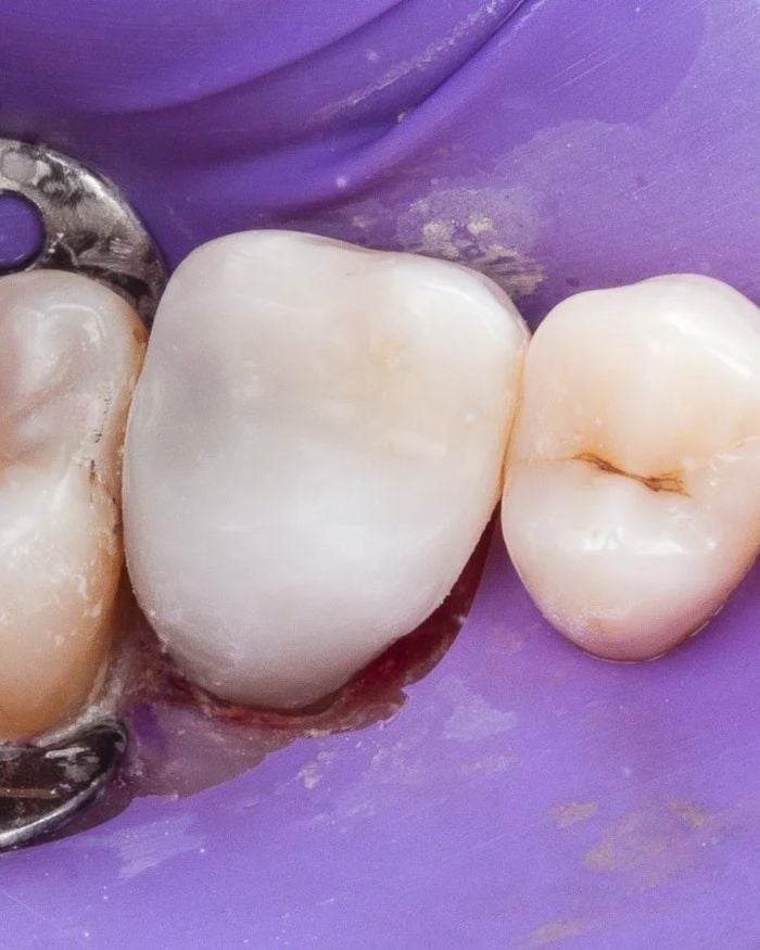 After: the molar restored with tooth-coloured material
