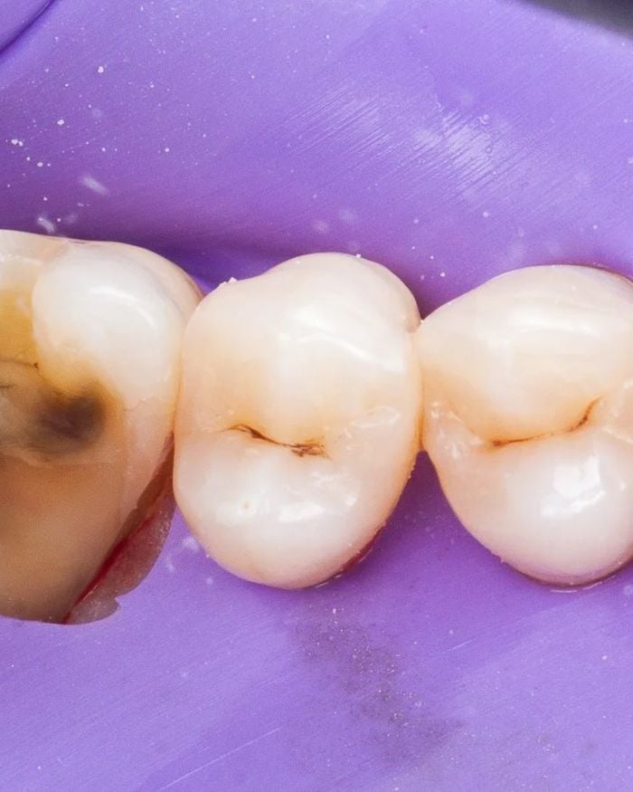 Before: a molar with a dark area of decay, isolated with a rubber dam