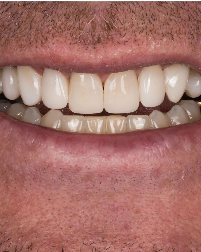 After: the upper front teeth rebuilt in a lighter, even shape