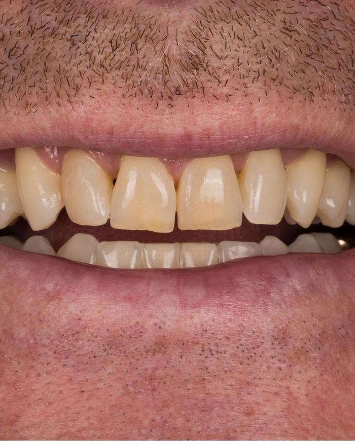 Before: worn, yellowed upper front teeth with small spaces near the gums