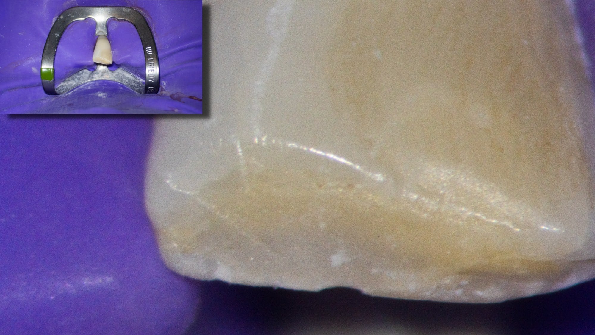 A close-up of a front tooth with a dental clamp, seen under magnification