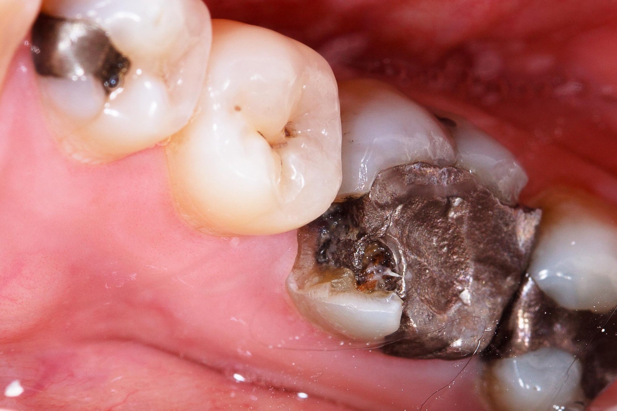 A close-up of worn silver fillings in back teeth