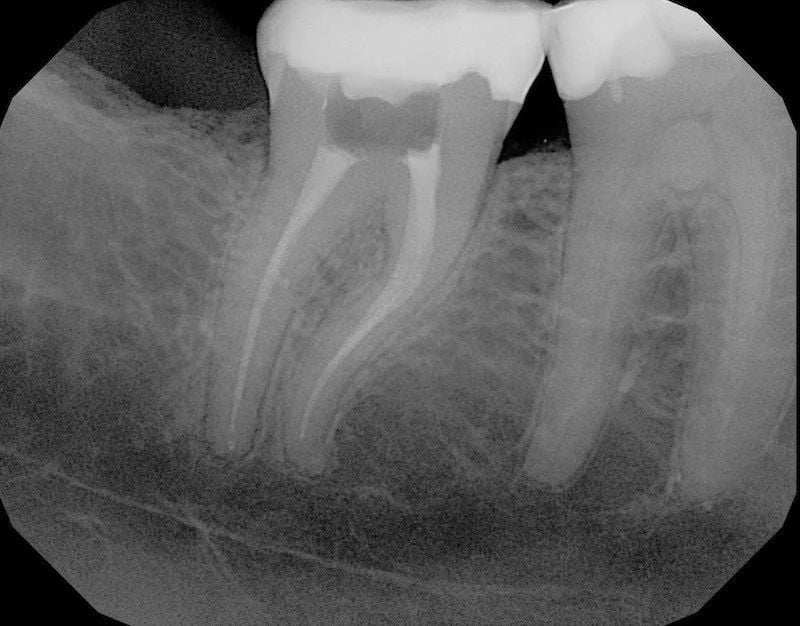 A dental x-ray of a molar with a completed root canal filling